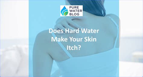 What Is Water Itch at Aileen Markham blog