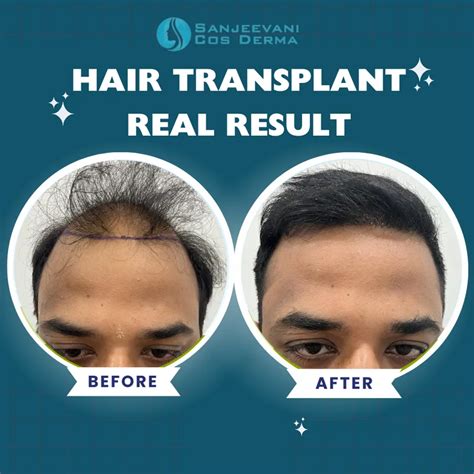 Hair Transplant Results - Sanjeevani Cos Derma | Before & After Gallery ...