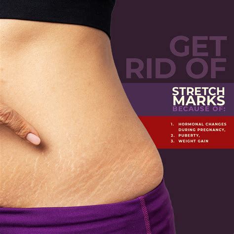 Stretch Marks Removal Cream, Stretchmarks Removal Cream- ARM