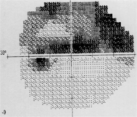 Image result for Check Visual Fields