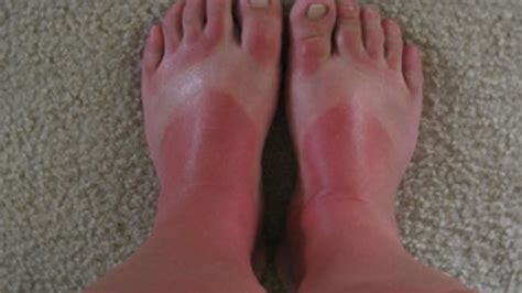 TMZ's Summer Sunburn Snapshots Contest