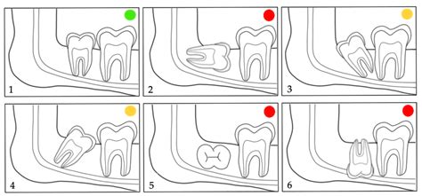 Eruption Pattern of Third Molars in Orthodontic Patients Treated with ...