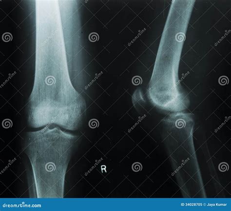Normal Knee Left Image And Osteoarthritis Knee Right Image Lateral View | CartoonDealer.com ...