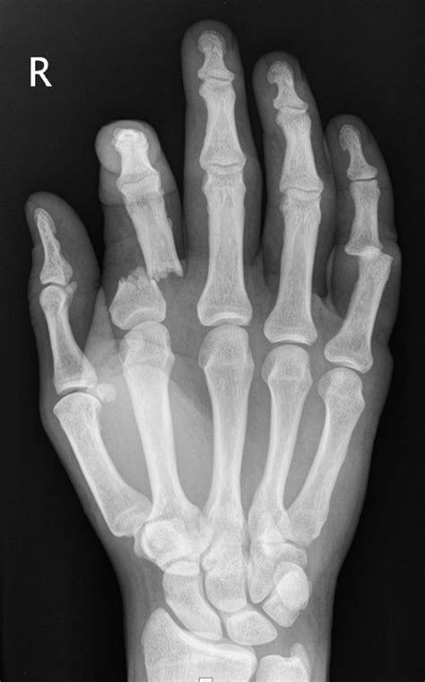 X Ray Of A Broken Hand Things You Didn39t Know