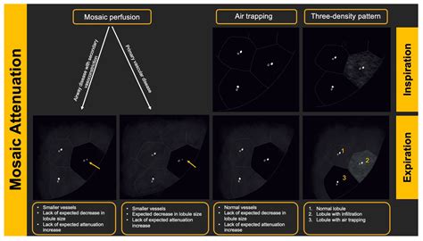 Imaging of Hypersensitivity Pneumonitis | Encyclopedia MDPI