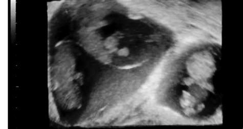 Trillizos en camino | BabyCenter
