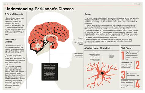 Lewys Disease Life Expectancy : Lewy Body Dementia: Symptoms, Causes ...