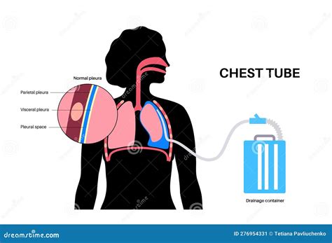 When To Remove Chest Tube For Pneumothorax | The Tube