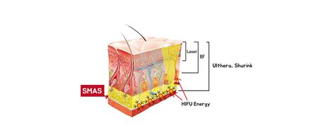 Thermage vs Ultherapy: Which one is right for you? - Jivaka Beauty