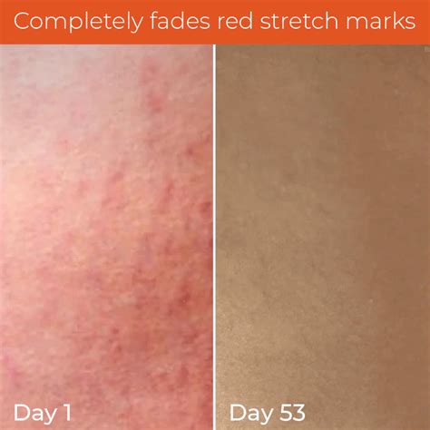 Pregnancy safe and safe for lactation women Skin tightening body cream ...