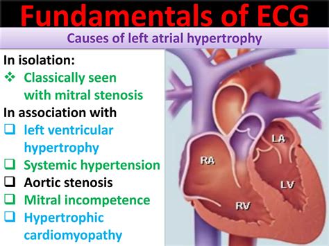 P wave abnormalities in ECG | PPSX