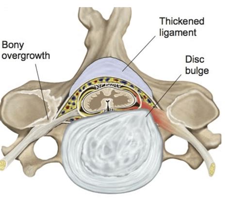 Kuvatulokset haulle cervical radiculopathy