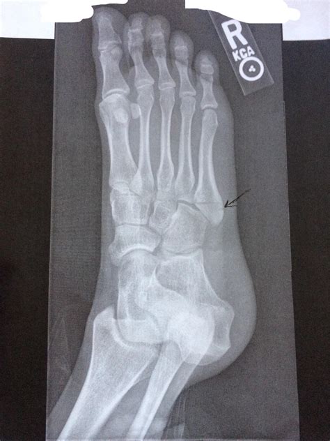 Pseudo Jones Fracture