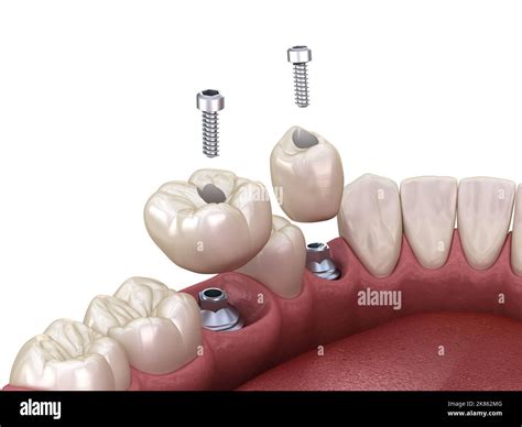 Dental Implant With Screw at Stephanie Trumble blog