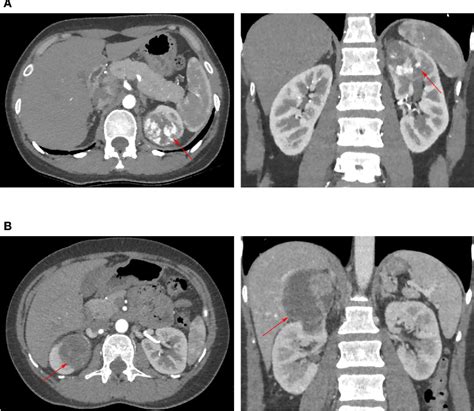 Image result for Retroperitoneal Approach Nephrectomy