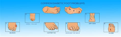 Best Diabetic Foot Clinic in Bhopal, Dr Sunil Rathore, India - Bansal ...