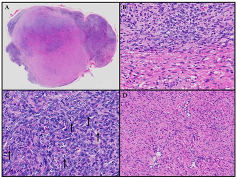 A Clinicopathology Review and Update of Epstein–Barr Virus-Associated ...