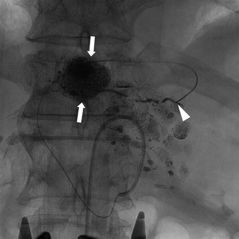 Chemoembolization of the Left Inferior Phrenic Artery in Patients With Hepatocellular Carcinoma ...