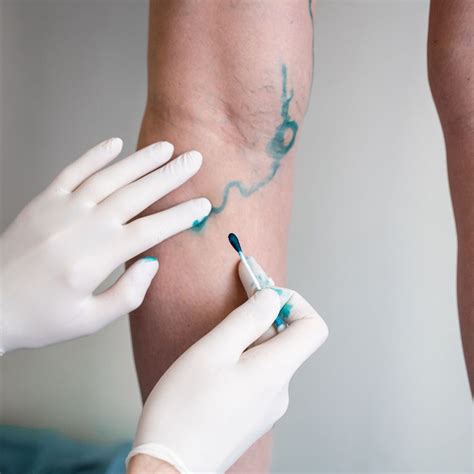 Abklärung und Therapiewahl bei Krampfadernerkrankungen - Dermatologie ...