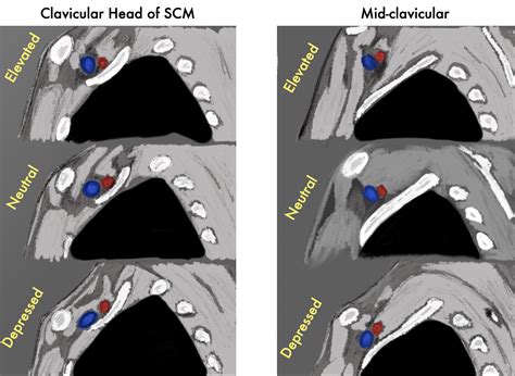 Subclavian Vein Cannulation