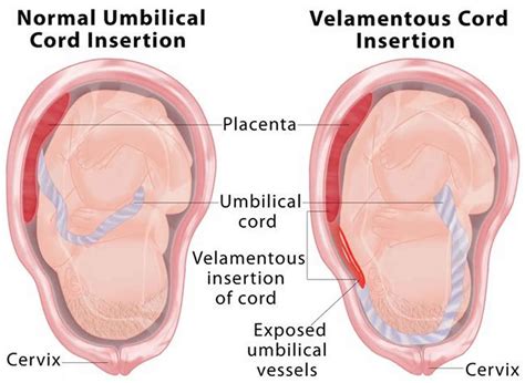 Velamentous cord insertion causes, risks, diagnosis & delivery