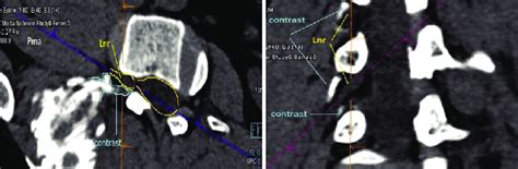 Image result for Contralateral Oblique View