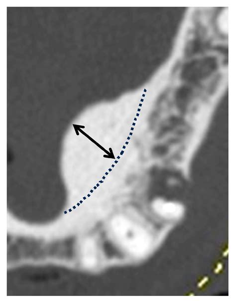 Computed Tomographic Analysis of Mandibular Tori and Their Relationship to Remaining Teeth