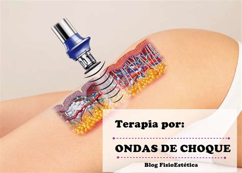 Terapia por Ondas de Choque | FisioEstética