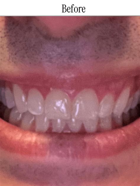 Image result for Best Toothpaste for White Teeth