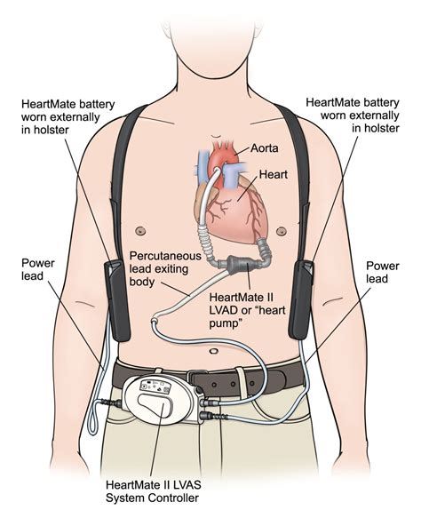 Is A Life Vest A Heart Assist Device at Norman Nelson blog