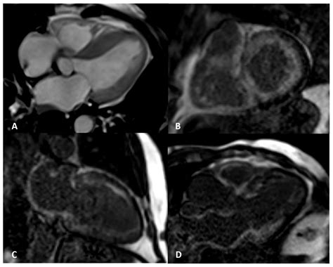 Role of Cardiovascular Magnetic Resonance in Cardiac Amyloidosis: A ...