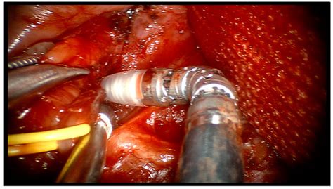 Hybrid Exoscopic and Robotic Transoral Removal of a Bilateral Hilar ...