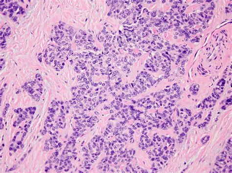 Pathology Outlines - Desmoplastic small round cell tumor