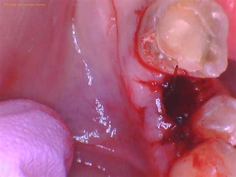 Image result for Stitches After Tooth Extraction