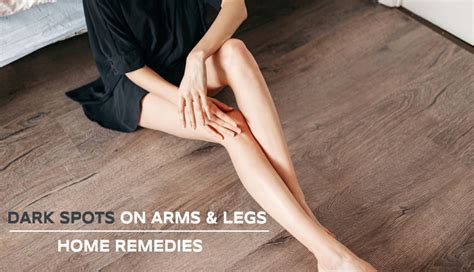 5 Remedies To Get Rid of Dark Spots From Arms and Legs - lifeberrys.com