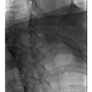 Image result for Contralateral Oblique View