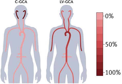 Giant cell arteritis, causes, symptoms, diagnosis, treatment & prognosis