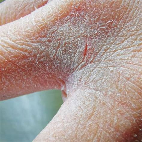 Lichen planus