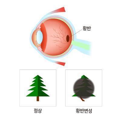 "흡연·음주, 황반변성 위험↑" - 나무뉴스