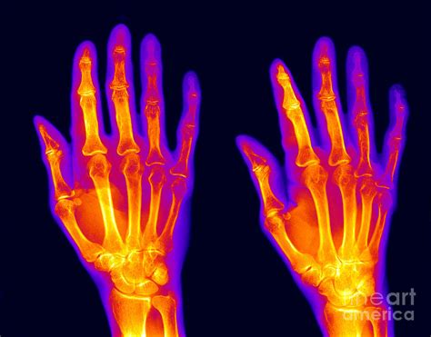 Image result for Normal Hand