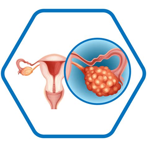 Quistes de Ovario - GINECIRUGIA