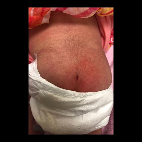 Newborn with a sacral dimple | Pediatric Radiology Case | Pediatric ...