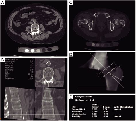 Tomo-densitometría QCT