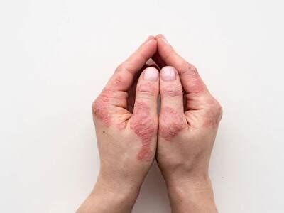 Why Atopic Dermatitis Flare-Ups Occur More Frequently In Winters ...