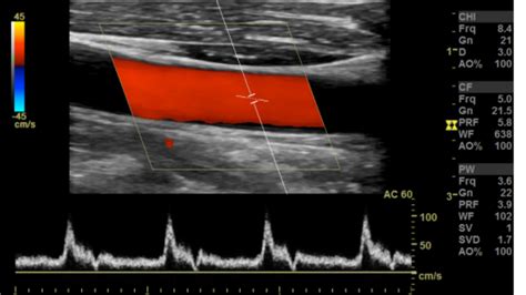 Arterial Doppler/Duplex of the Lower Extremities – Sonographic Tendencies in 2022 | Lower ...