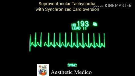 Image result for Synchronized Cardioversion SVT