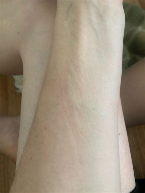 Wondering if anyone has had anything like this? Had this Random skin swelling with weird lines ...