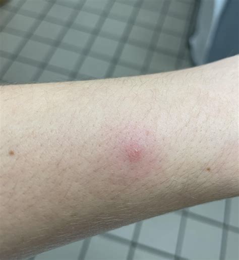 What is this bite? Doesn’t itch or irritate me very much. Just curious ...