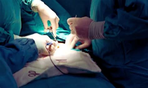 Surgery Outperforms Antibiotics for Acute Uncomplicated Appendicitis in ...