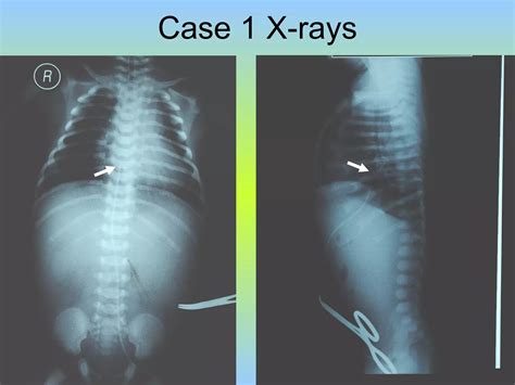 Umbilical Venous Catheter | PPT